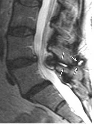 болезнь Бааструпа