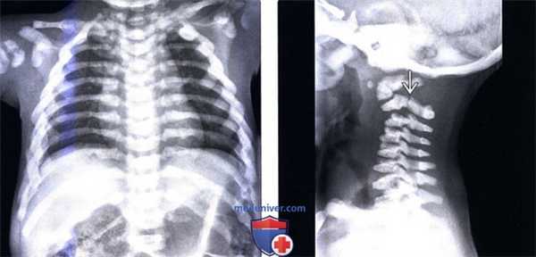 Рентгенограмма, МРТ позвоночника при остеопетрозе