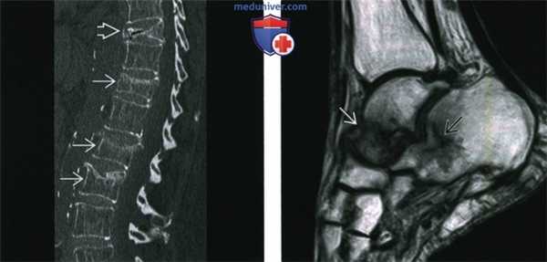 Рентгенограмма, КТ, МРТ, УЗИ при первичном остеопорозе