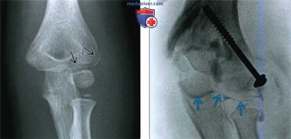 Рентгенограмма, КТ, МРТ, УЗИ при переломе латерального мыщелка локтевого сустава