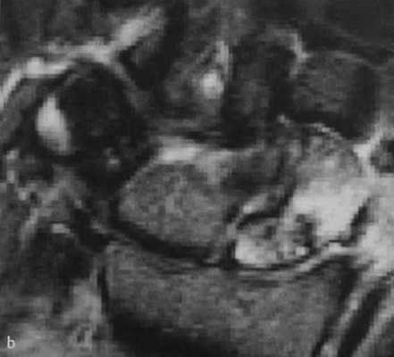 Снимки МРТ и КТ. Перелом ладьевидной кости