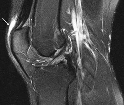 Воспаление передней подкожной преднадколенниковой сумки на МРТ
