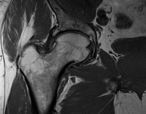 Импиджмент синдром на МР-фото
