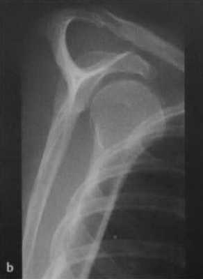 Снимки МРТ и КТ. Вывих плечевого сустава