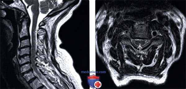 МРТ подострой комбинированной дегенерации