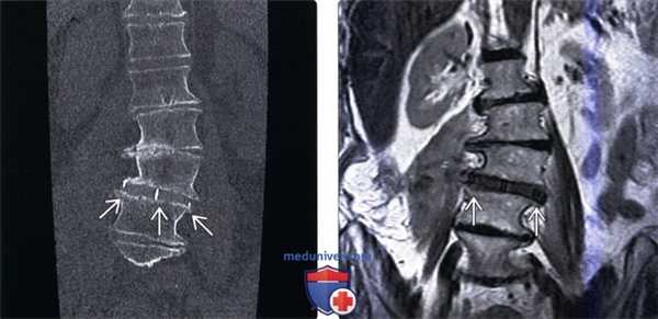 КТ при дегенеративном сколиозе позвоночника