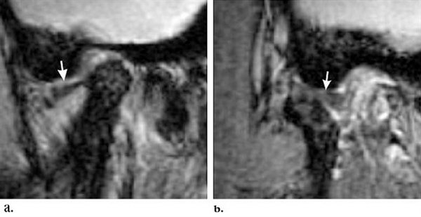 На МРТ вправляемый вывих