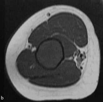 Снимки МРТ и КТ. Фиброзная дисплазия - болезнь Брайцева