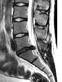грыжа диска- сагитт