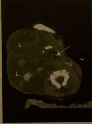 Снимки МРТ и КТ. Лимфангиома у детей