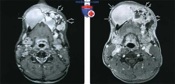 КТ, МРТ при амелобластоме
