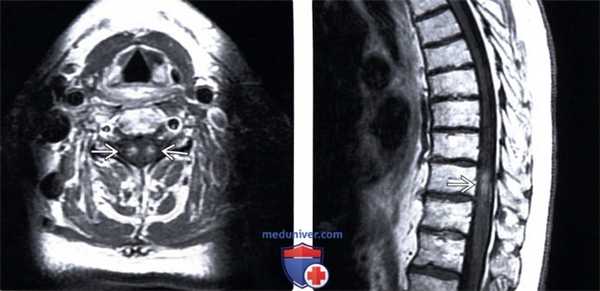 МРТ при паранеопластической миелопатии