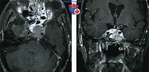 КТ, МРТ при плазмоцитоме основания черепа