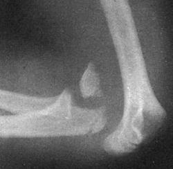 Рентгенограмма при переднем вывихе предплечья