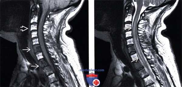 МРТ при паранеопластической миелопатии