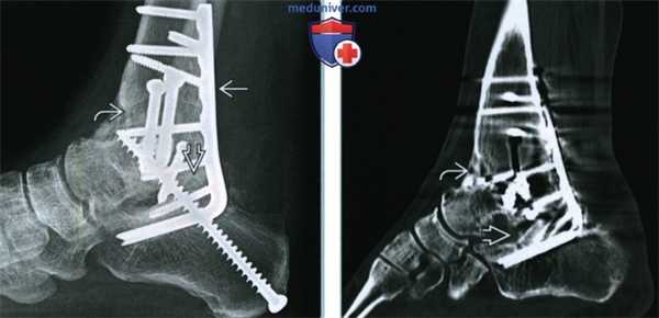 Артродез голеностопного сустава - лучевая оценка