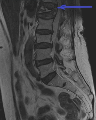 Что лучше при переломе: рентген или МРТ