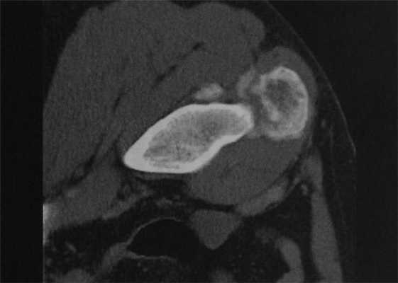 Снимки МРТ и КТ. Оссифицирующий миозит
