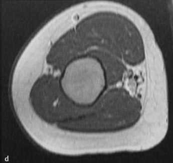 Снимки МРТ и КТ. Фиброзная дисплазия - болезнь Брайцева