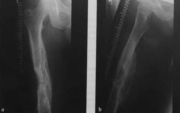 Снимки МРТ и КТ. Остеомиелит