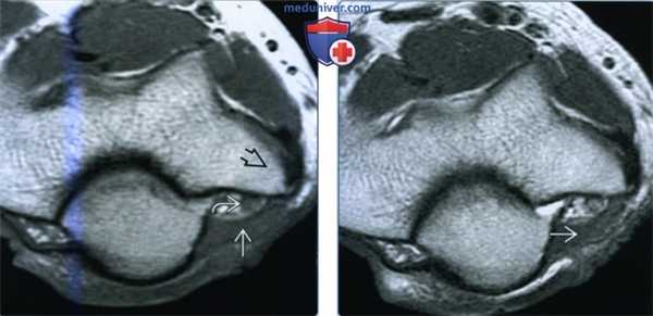 Признаки надблоково-локтевой мышцы