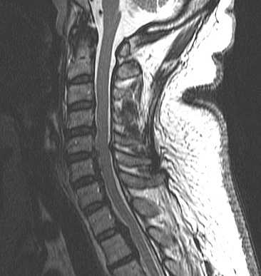 Японская болезнь-сагитт