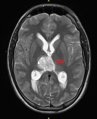 Герминома головного мозга