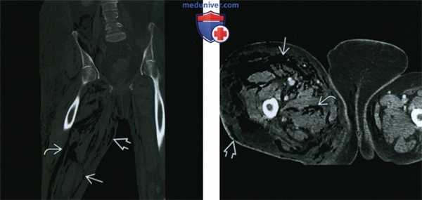 Некротизирующий фасциит - лучевая диагностика