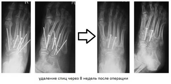 вывих стопы