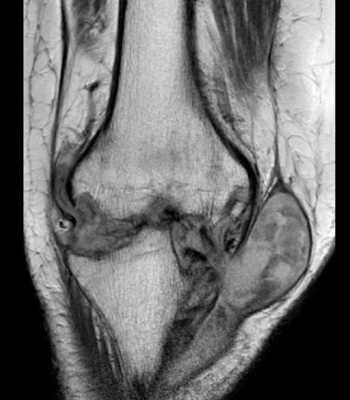 септический артрит колена с абсцессом