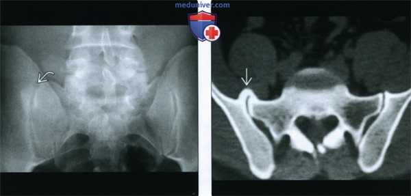 Рентгенограмма, КТ, МРТ при остеоартрозе осевого скелета