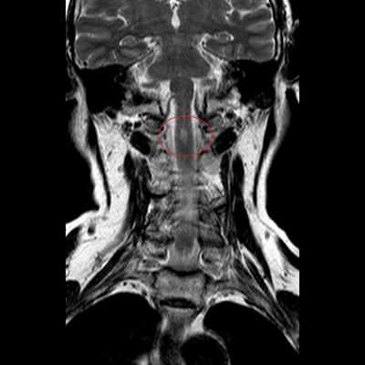 перелом зубовидного отростка на МРТ