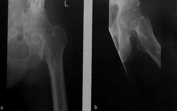 Снимки МРТ и КТ. Септический артрит