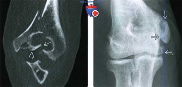 Рентгенограмма, КТ, МРТ, УЗИ при переломе медиального мыщелка локтевого сустава