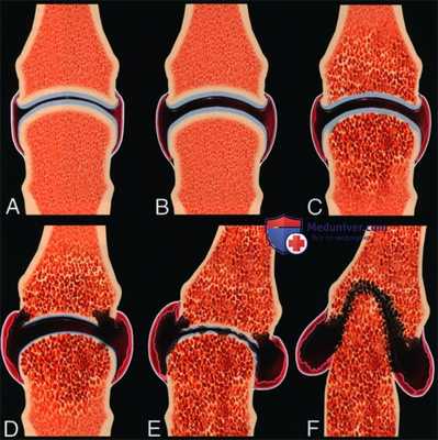 Ревматоидный артрит лучезапястного сустава и суставов кисти - лучевая диагностика