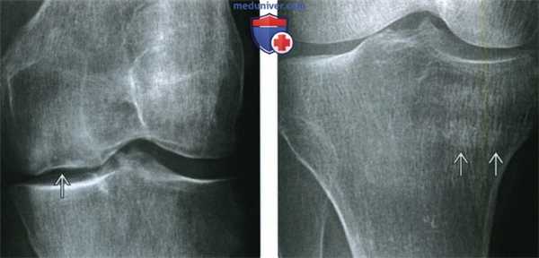 Рентгенограмма, КТ, МРТ, УЗИ при первичном остеопорозе