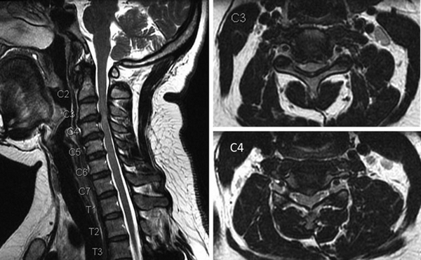 МРТ снимок шеи
