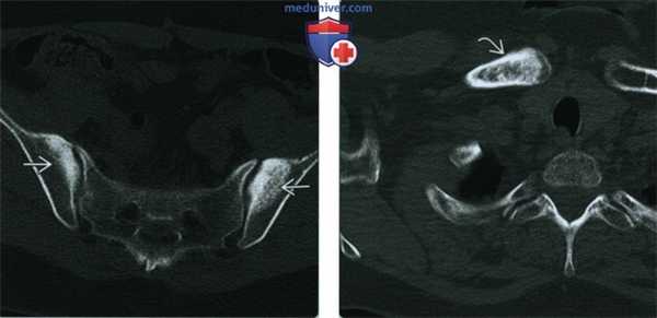 Конденсационный остеит - лучевая диагностика