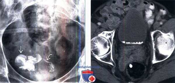 Рентгенограмма, КТ, МРТ при конкрементах мочевого пузыря