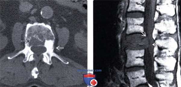 Рентгенограмма, КТ, МРТ литических костных метастазов позвоночника