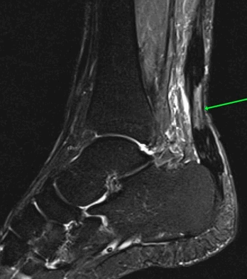 Расшифровка и как выглядят переломы на снимке МРТ