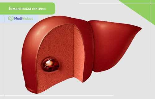 гемангиома печени у детей форум