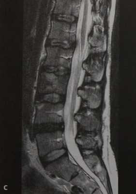 Снимки МРТ и КТ. Лимфома кости
