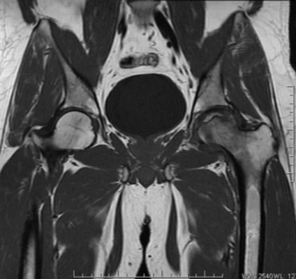 Импиджмент синдром на МР-фото