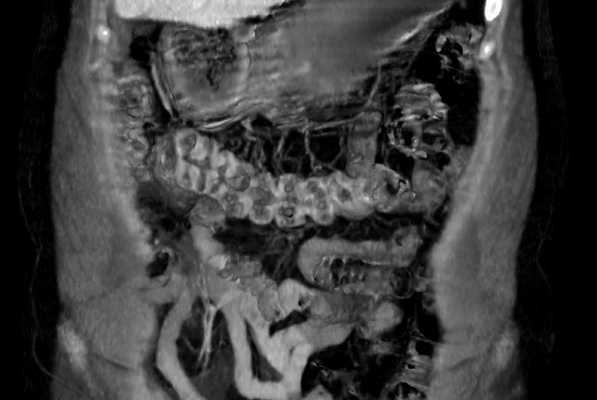 КТ или МРТ кишечника