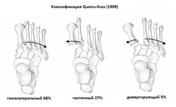 вывих в суставе лисфранка