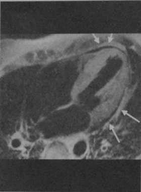 Снимки МРТ и КТ. Амилоидоз