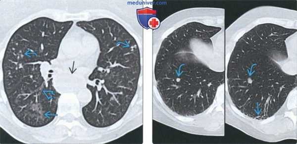 КТ изменения легких при системном склерозе (склеродермии)