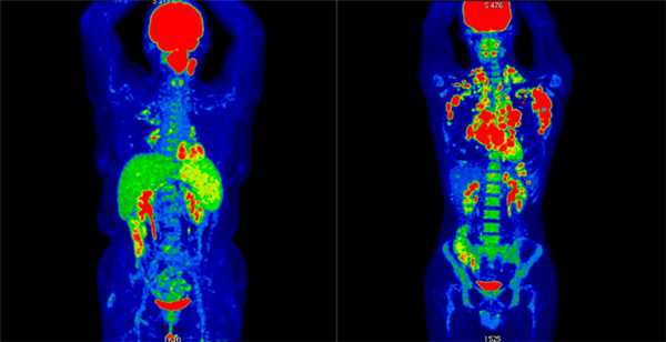 pet-ct-limfoma.jpg