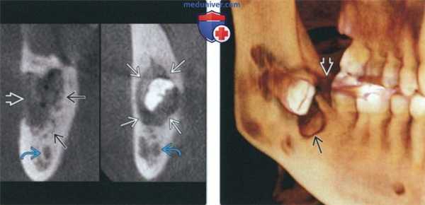 Лучевая диагностика центрального мукоэпидермиоидного рака челюсти